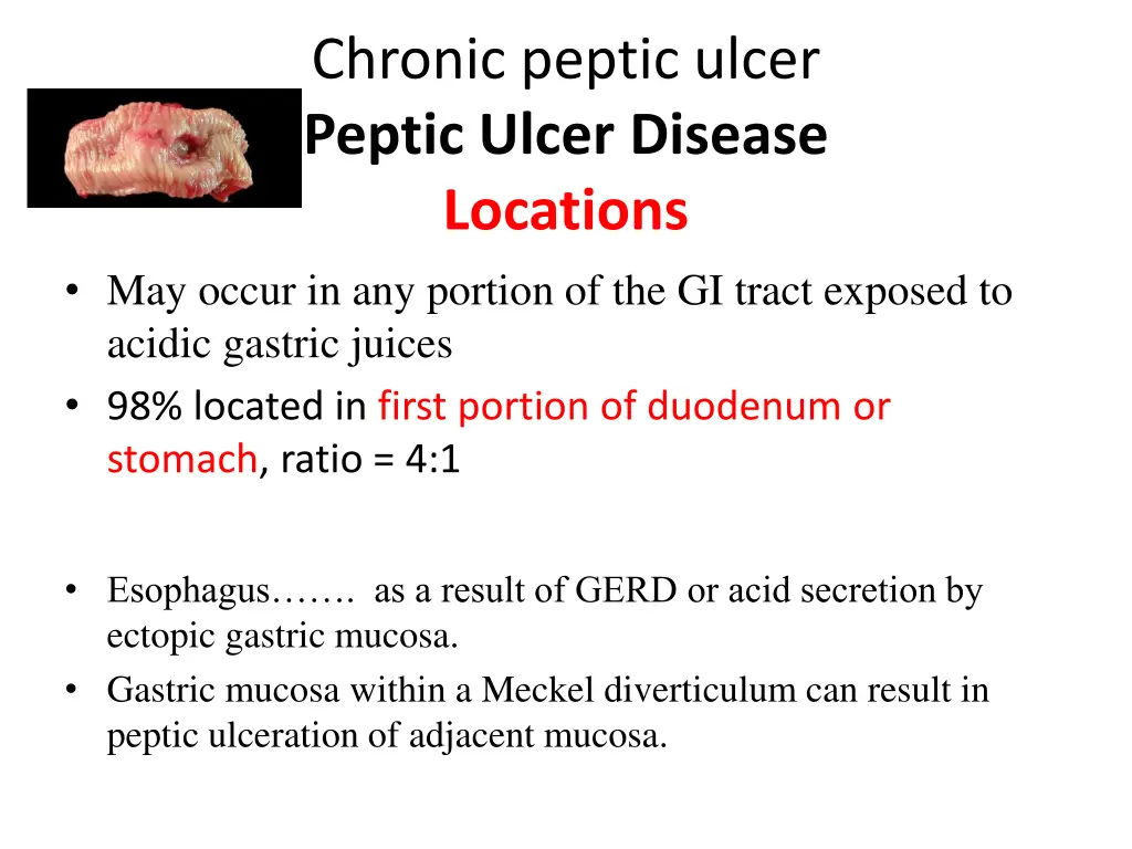 chronic peptic ulcer peptic ulcer disease