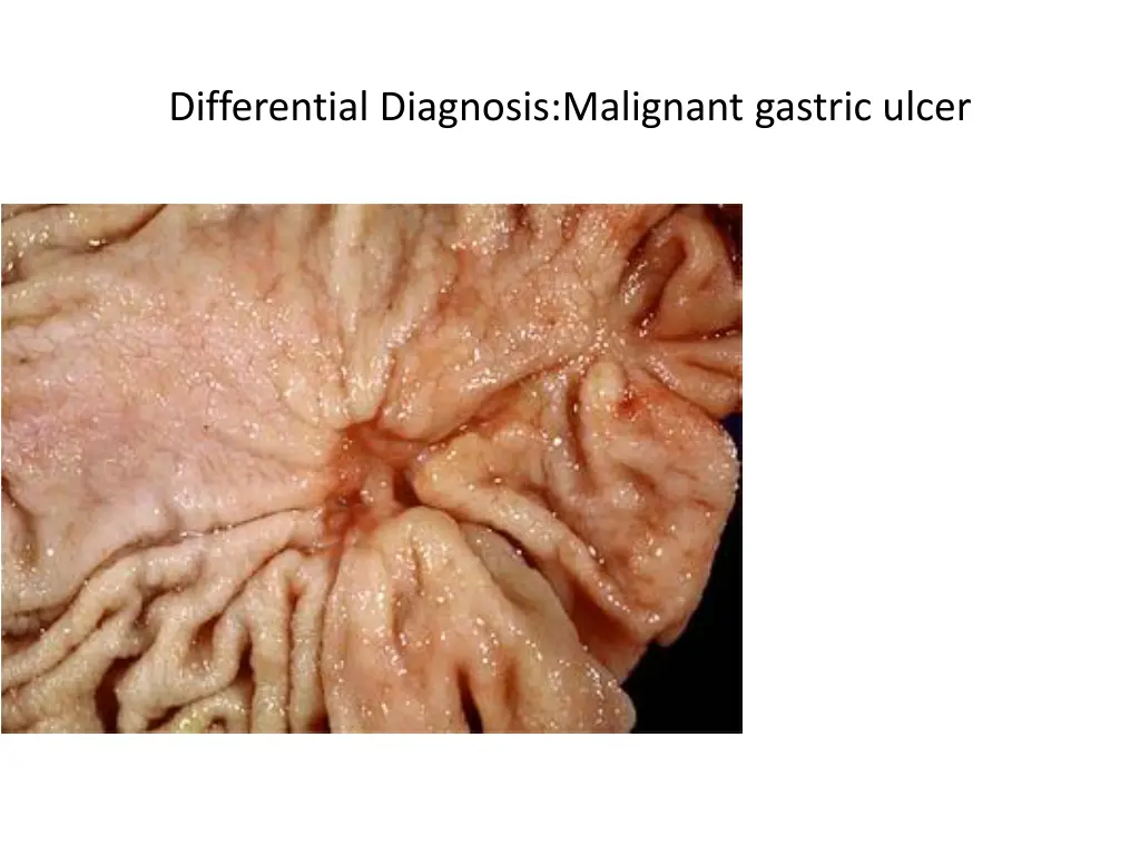 differential diagnosis malignant gastric ulcer