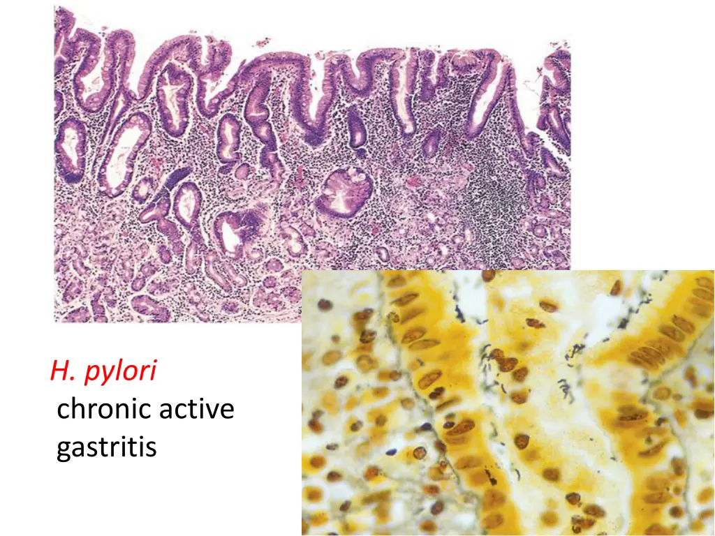 h pylori chronic active gastritis