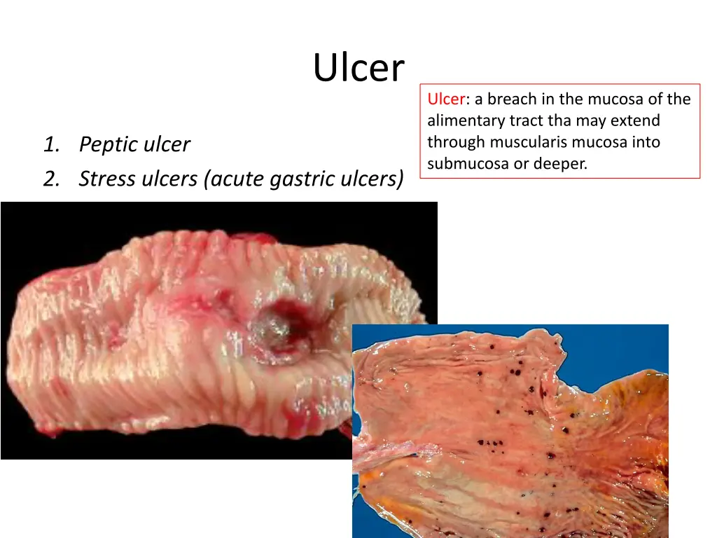 ulcer