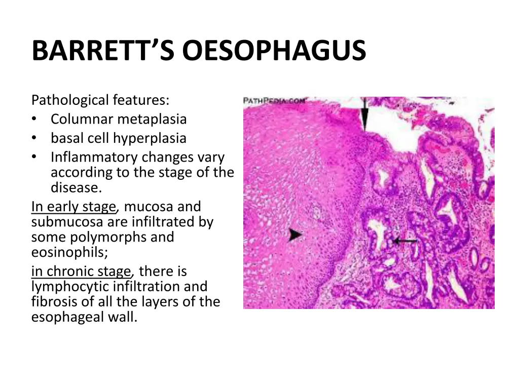 barrett s oesophagus