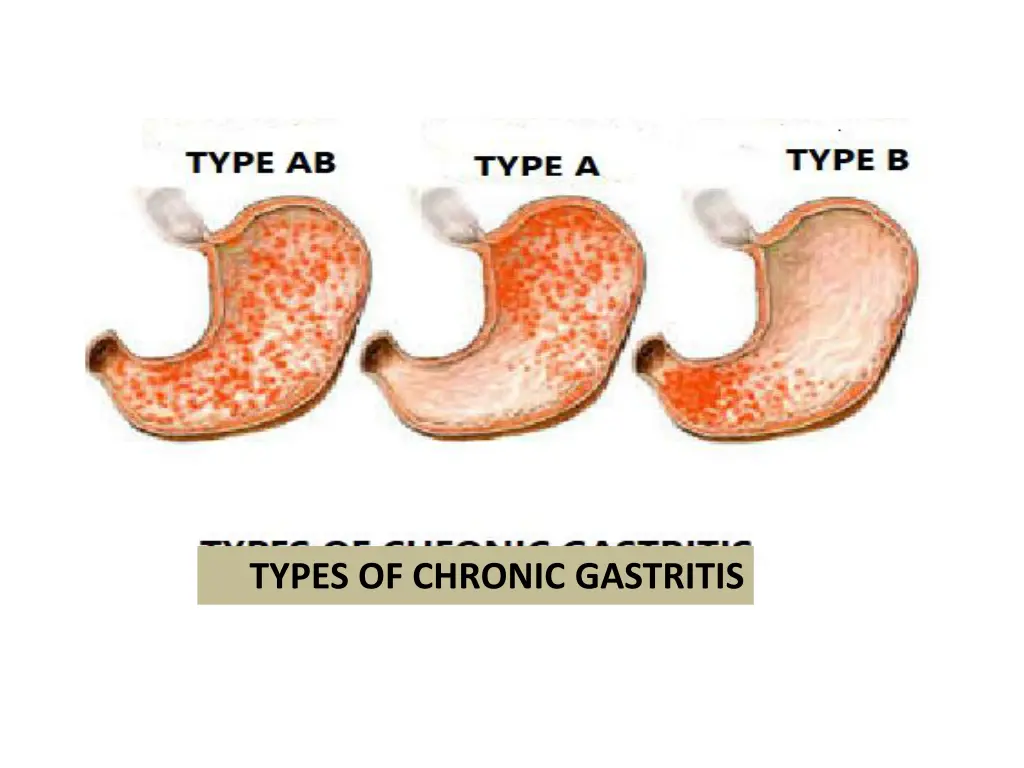 types of chronic gastritis