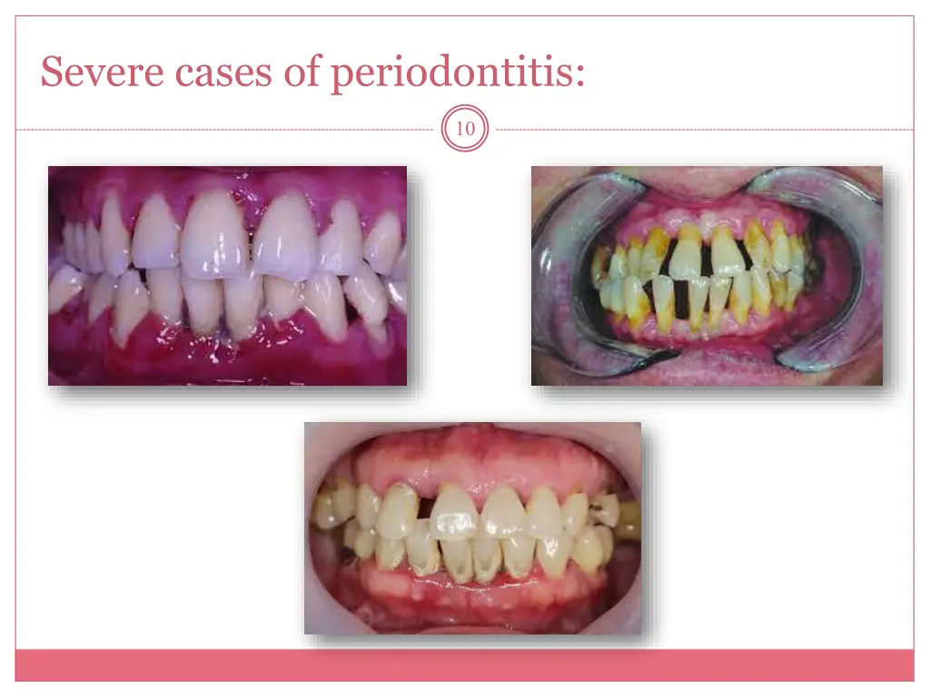 severe cases of periodontitis