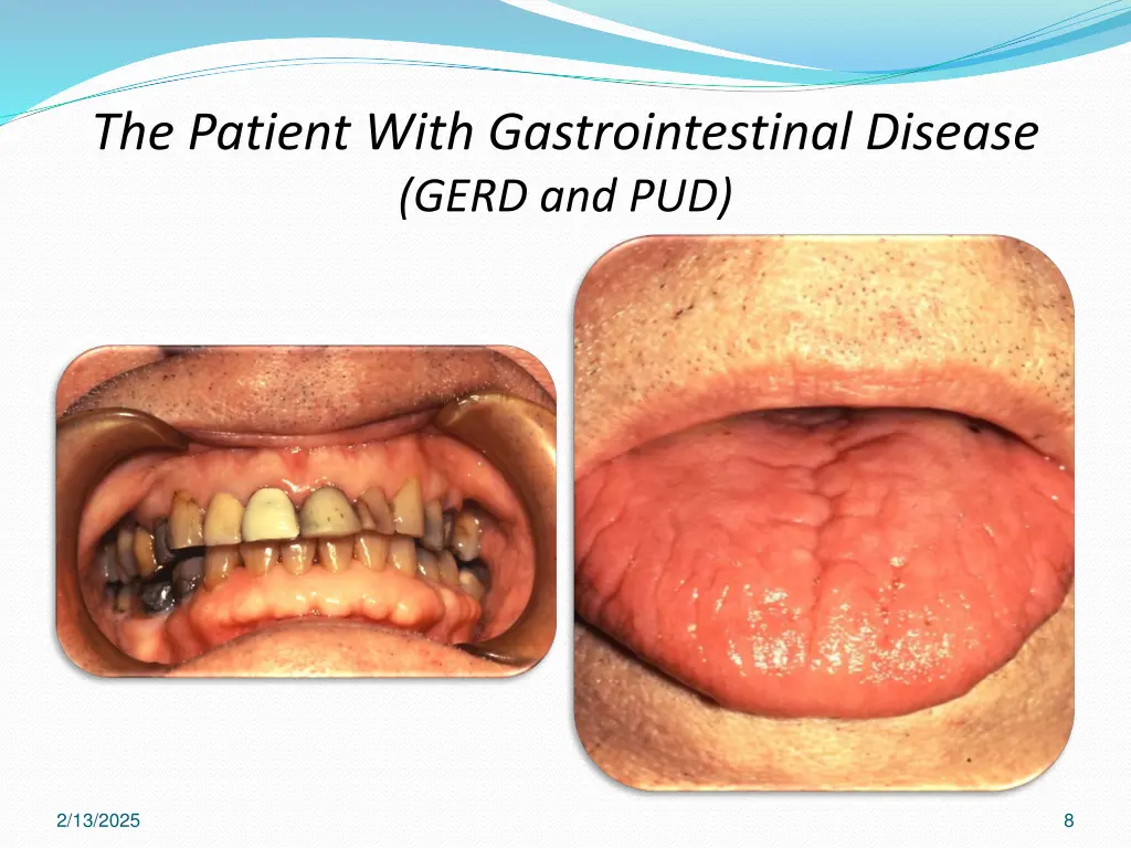 the patient with gastrointestinal disease gerd 4