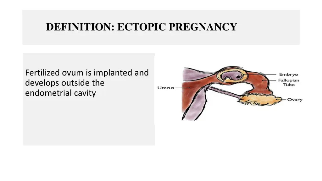 definition ectopic pregnancy
