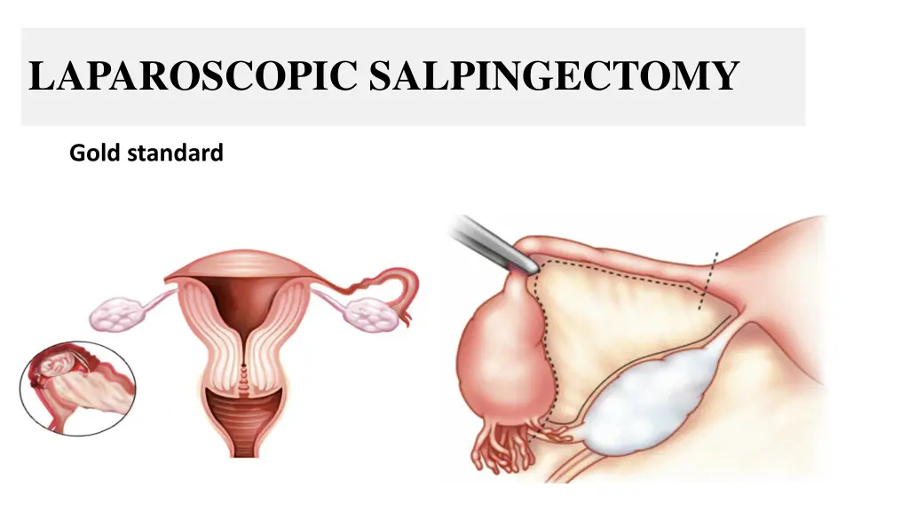laparoscopic salpingectomy