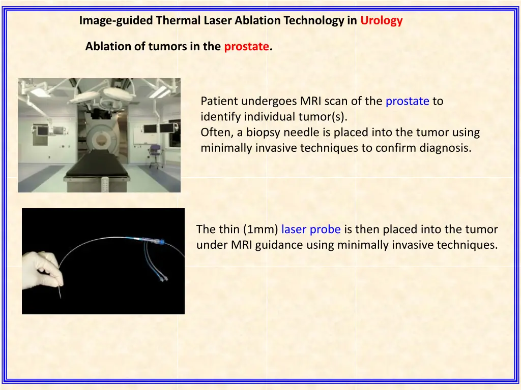 image guided thermal laser ablation technology 1