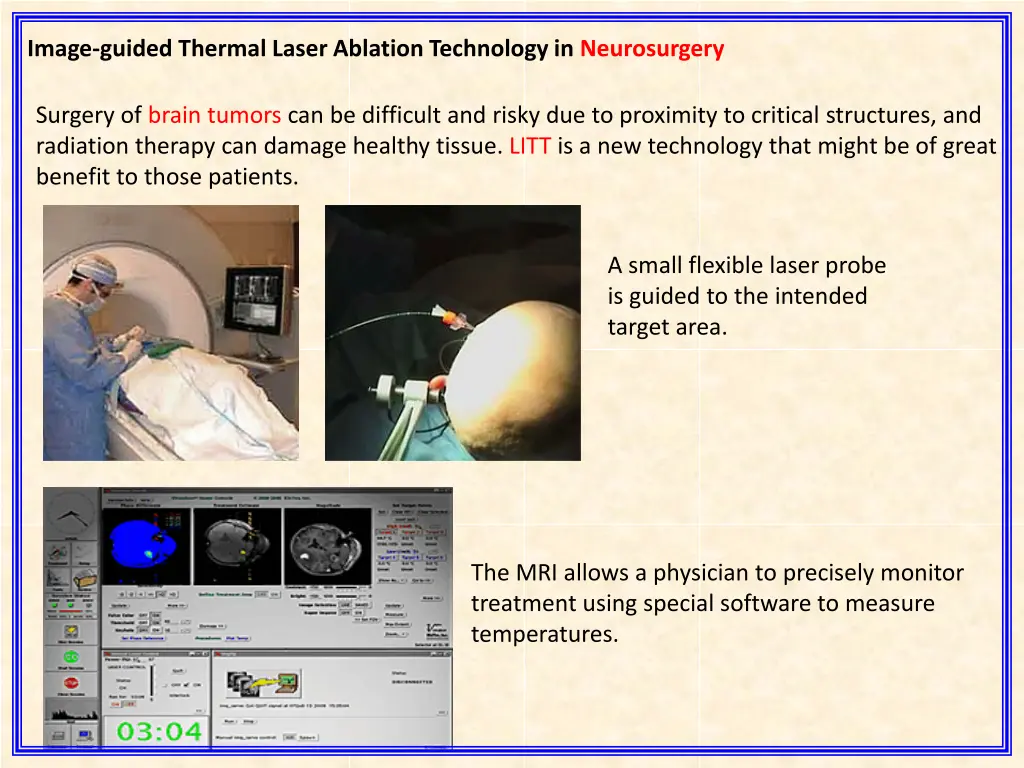 image guided thermal laser ablation technology 2