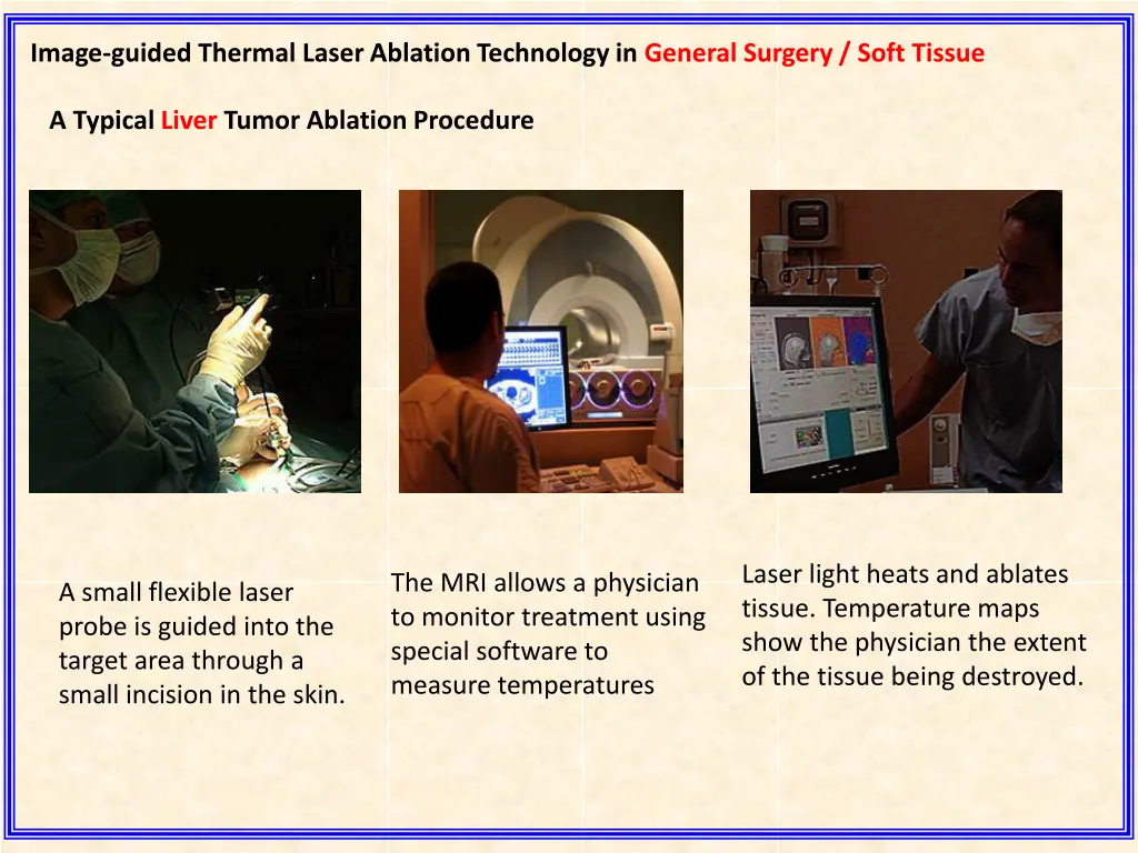 image guided thermal laser ablation technology