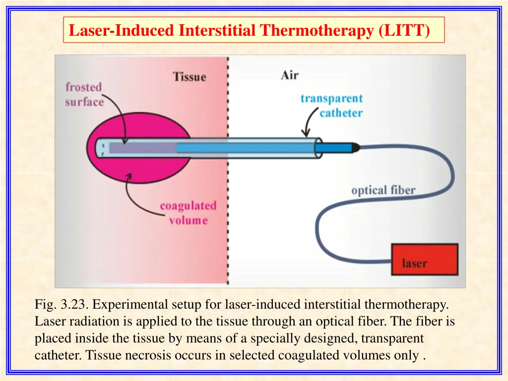 laser induced interstitial thermotherapy litt 3