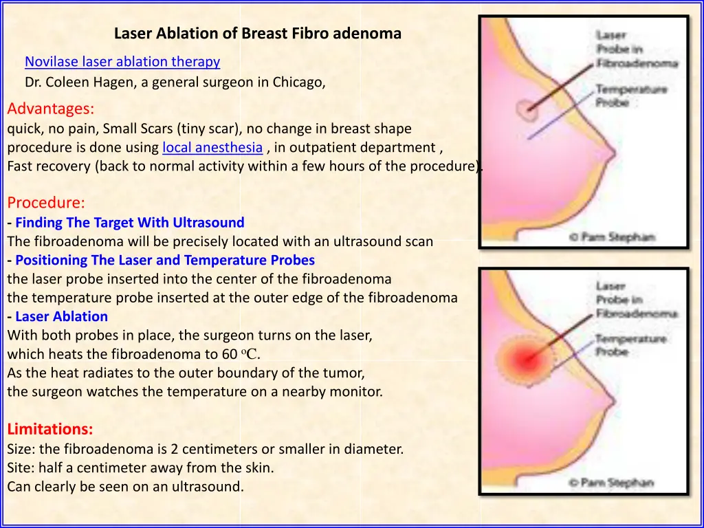 novilase laser placement