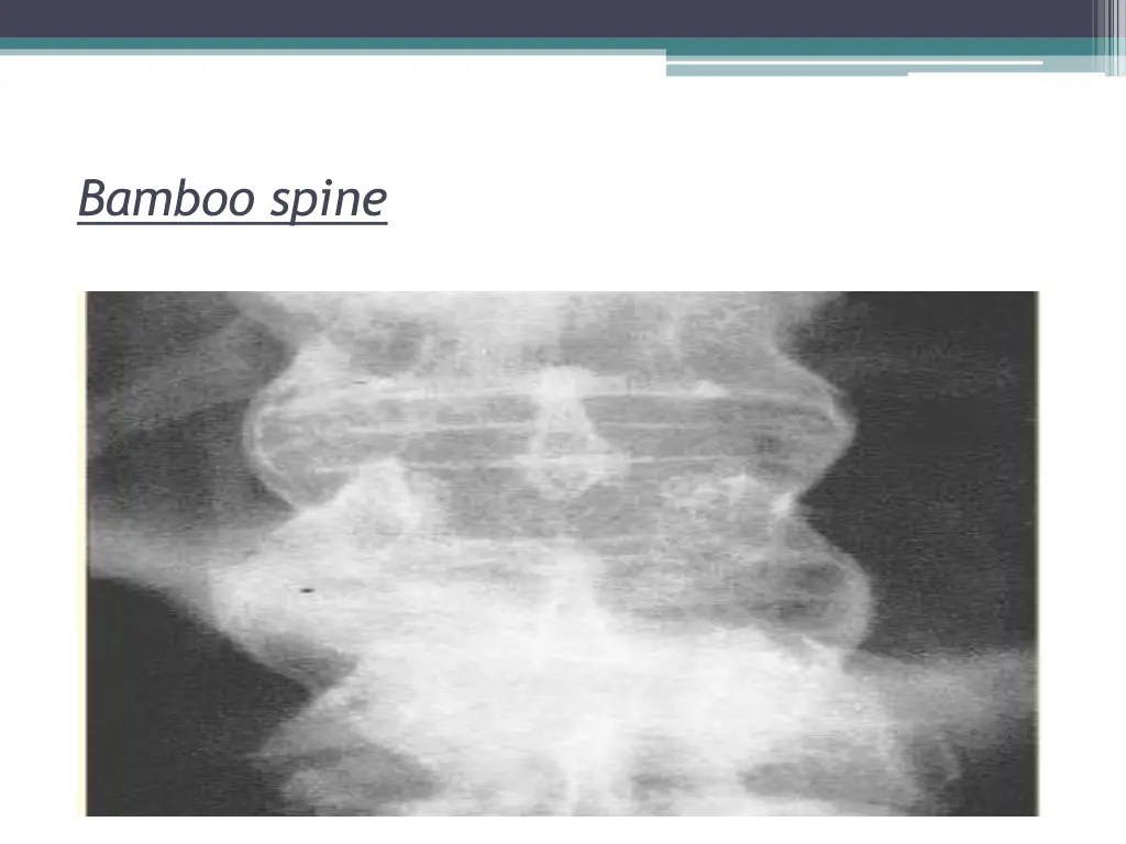 bamboo spine