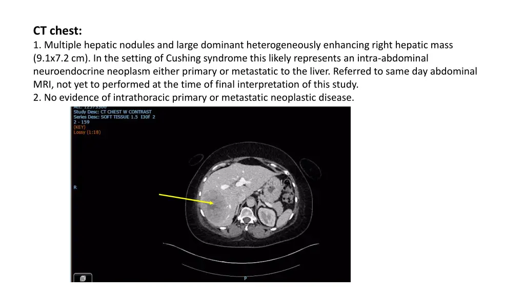 ct chest 1 multiple hepatic nodules and large