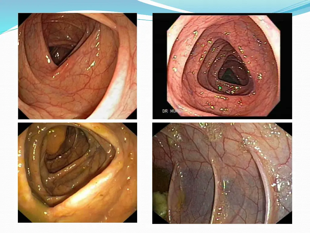 normal video colonoscopy showing characteristic