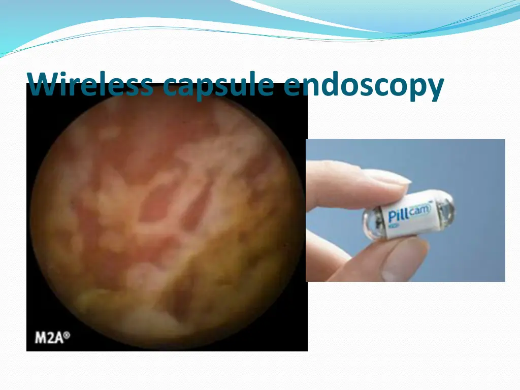 wireless capsule endoscopy