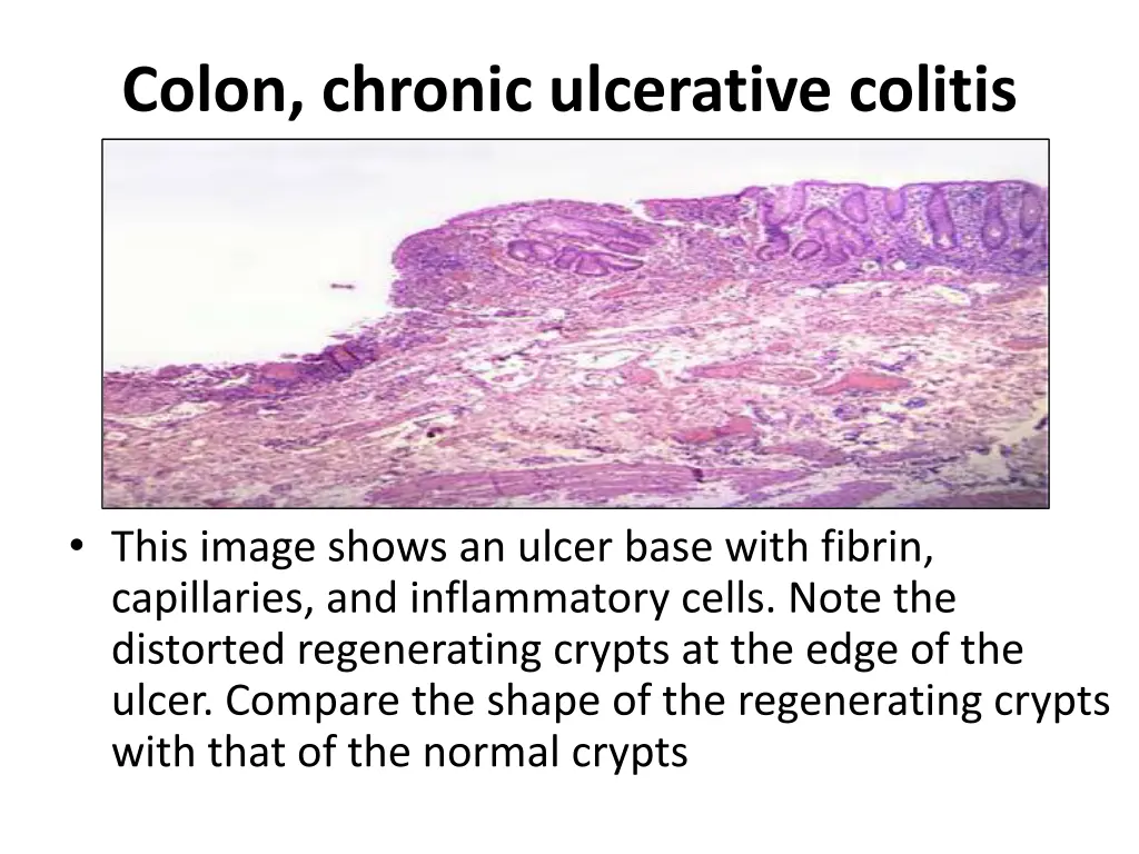 colon chronic ulcerative colitis 1