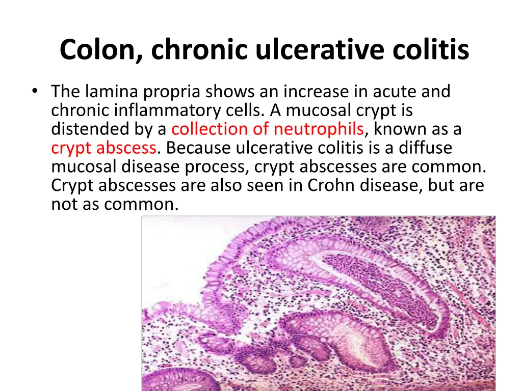 colon chronic ulcerative colitis 2