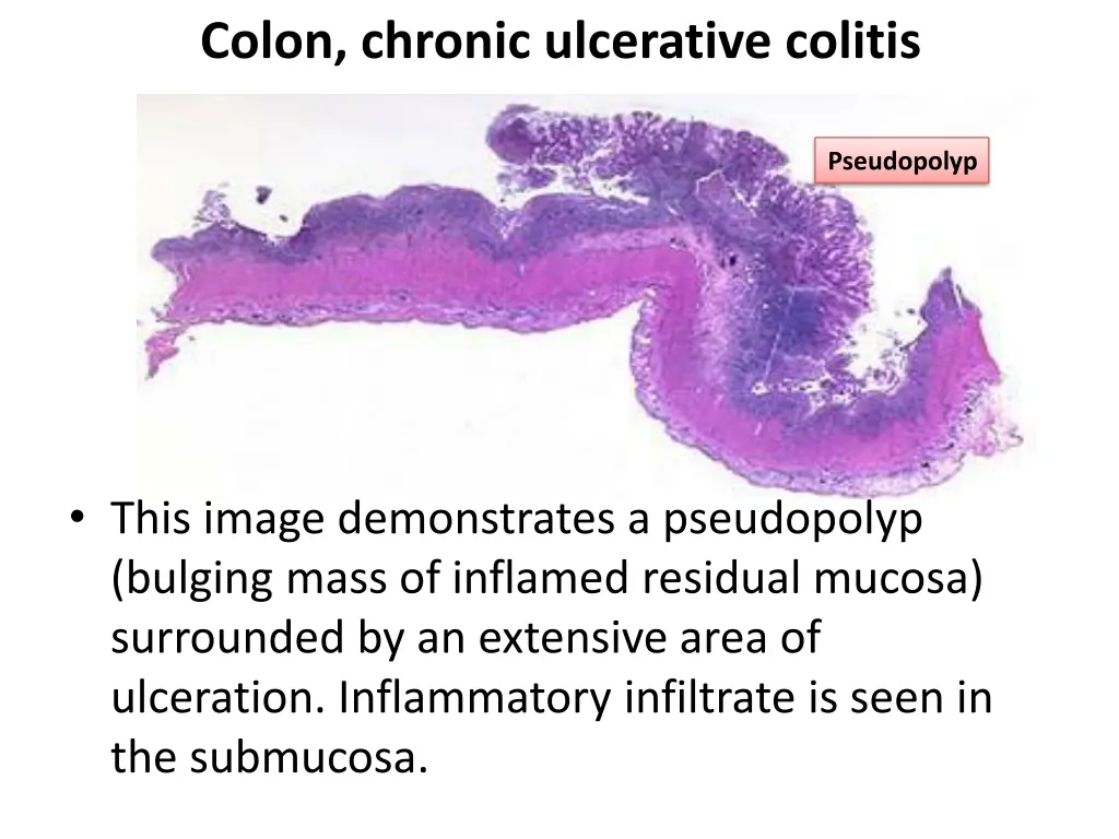 colon chronic ulcerative colitis