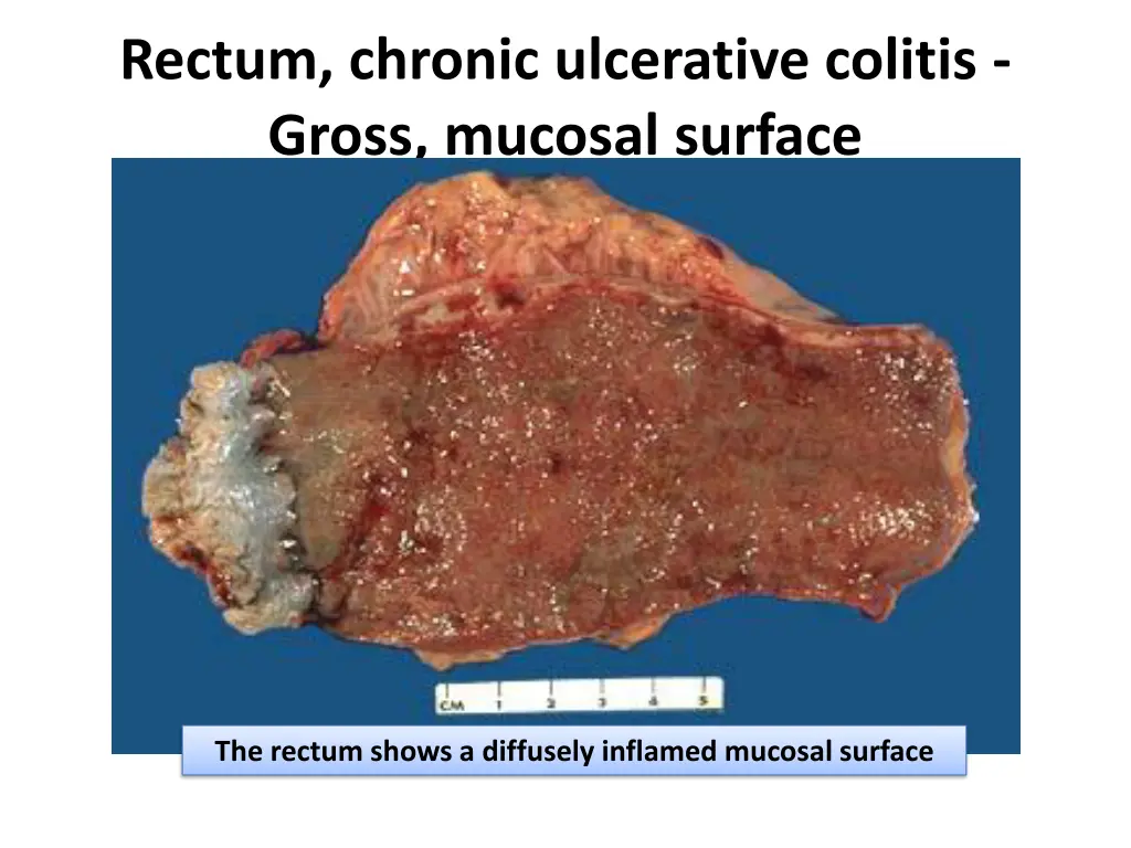 rectum chronic ulcerative colitis gross mucosal