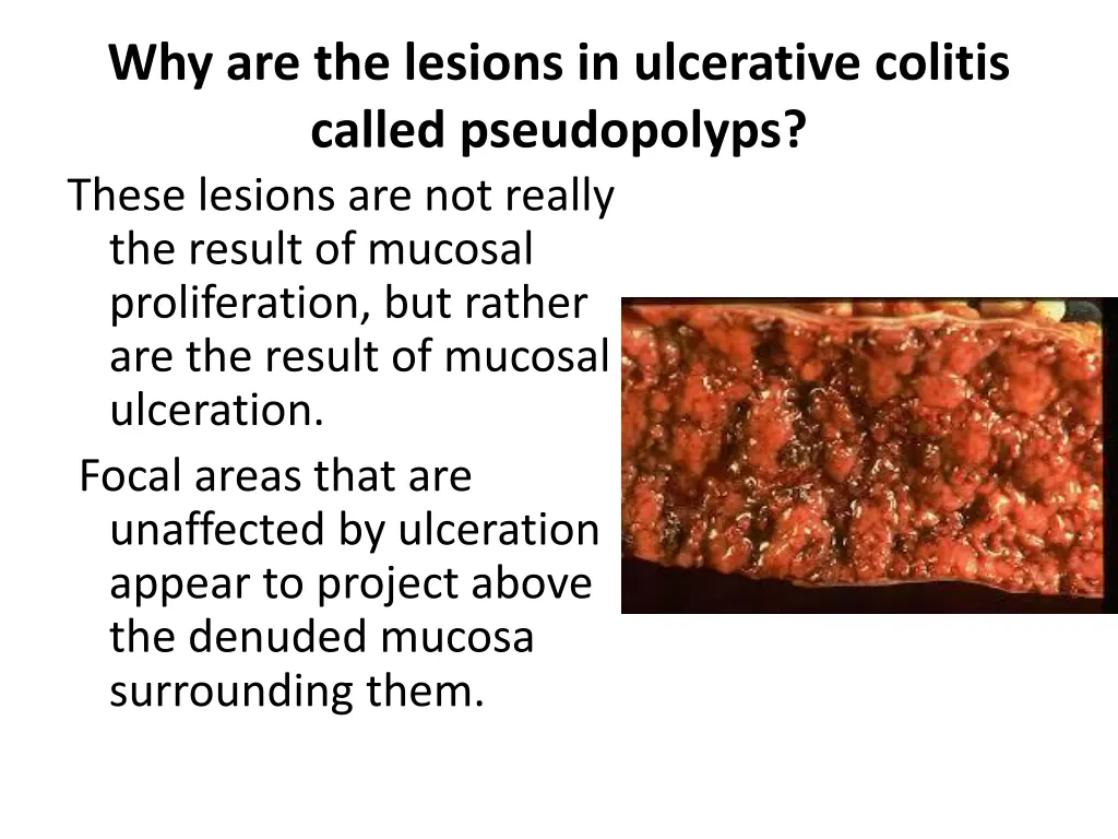 why are the lesions in ulcerative colitis called