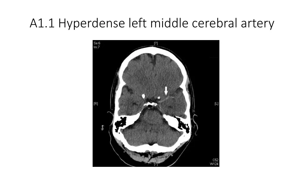 a1 1 hyperdense left middle cerebral artery
