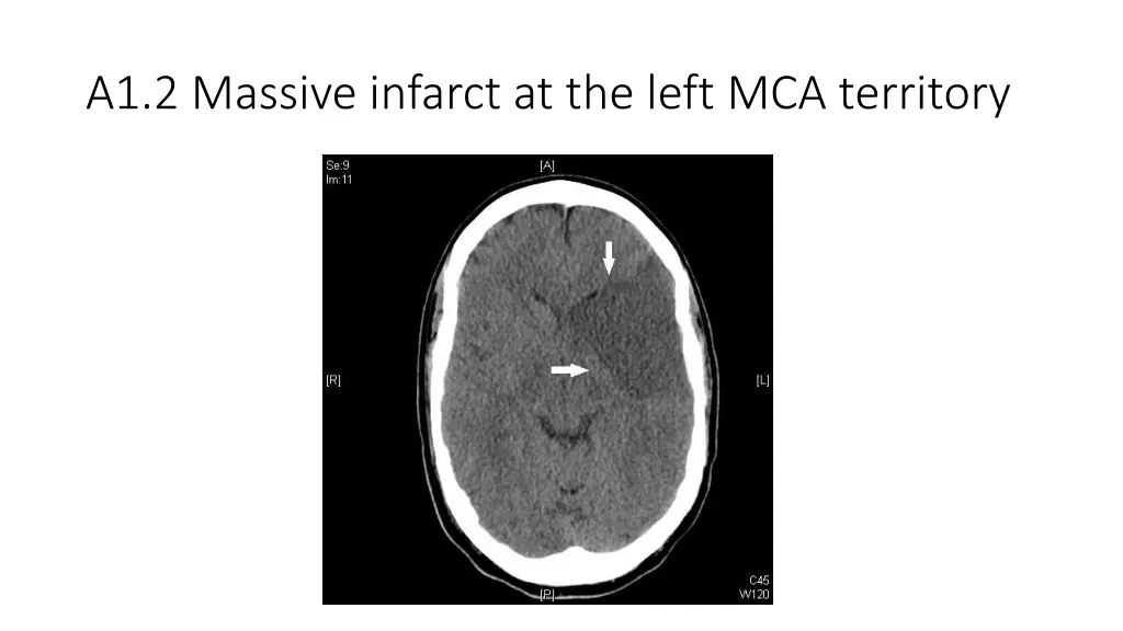 a1 2 massive infarct at the left mca territory