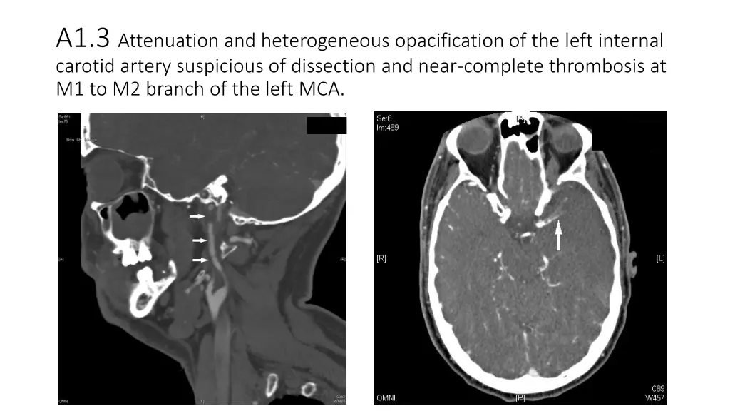 a1 3 attenuation and heterogeneous opacification