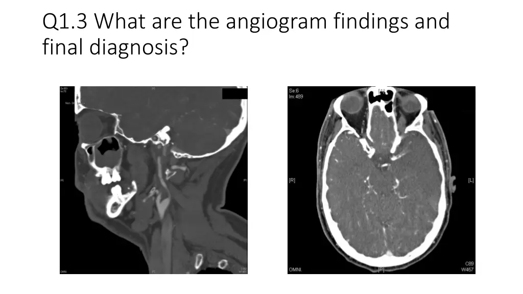 q1 3 what are the angiogram findings and final