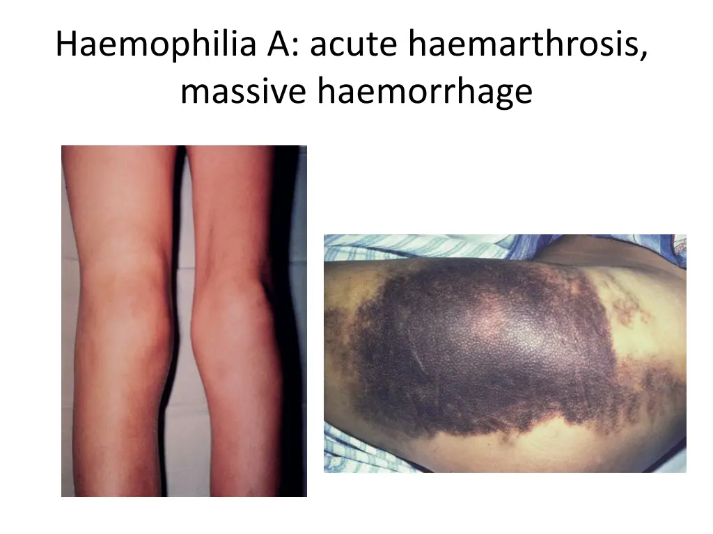 haemophilia a acute haemarthrosis massive