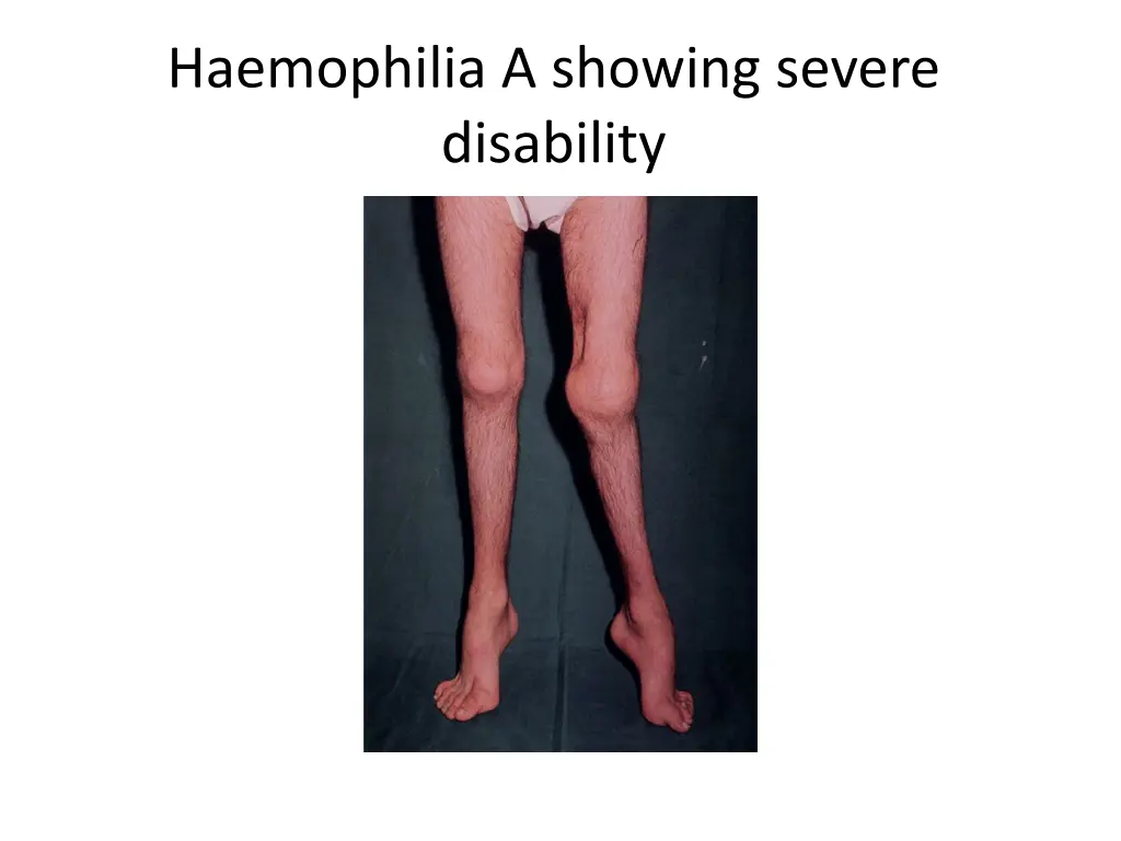 haemophilia a showing severe disability