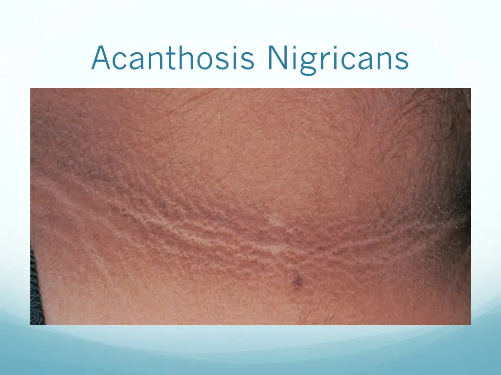 acanthosis nigricans