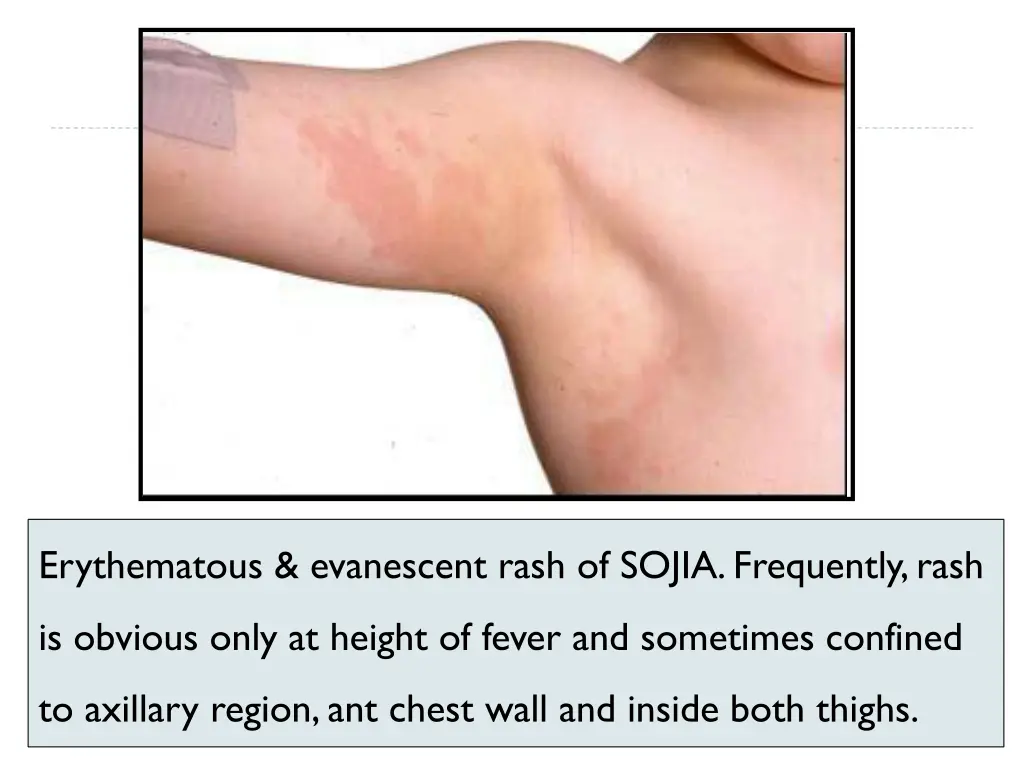 erythematous evanescent rash of sojia frequently