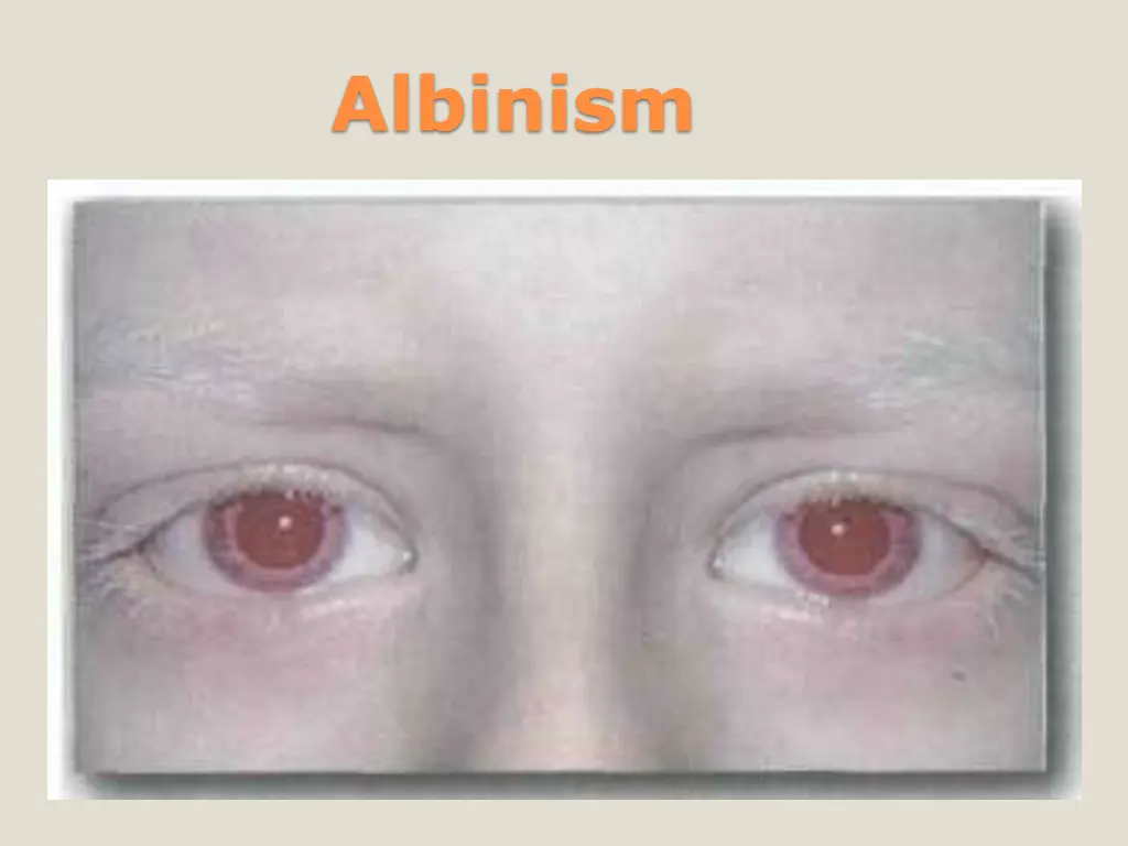 albinism