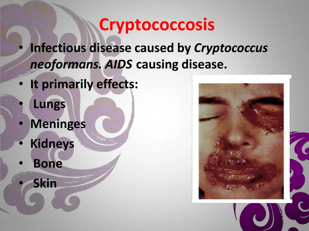 cryptococcosis