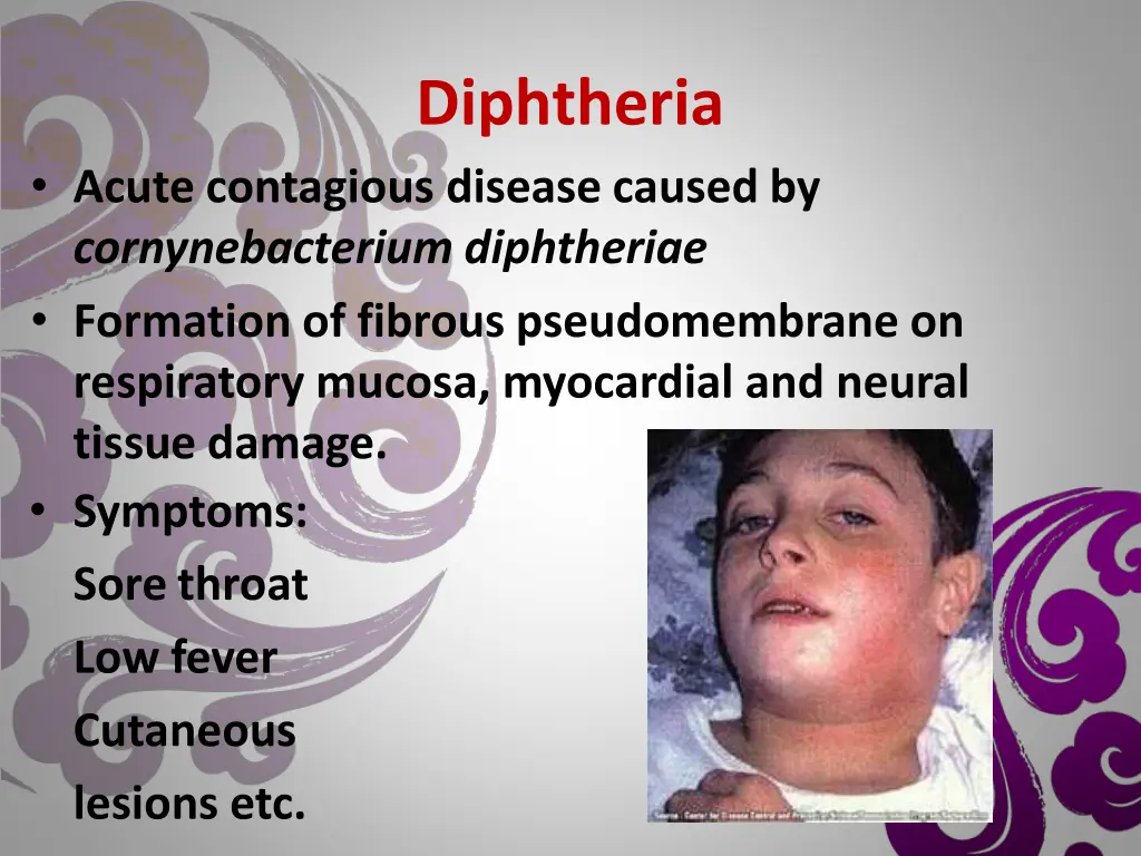 diphtheria