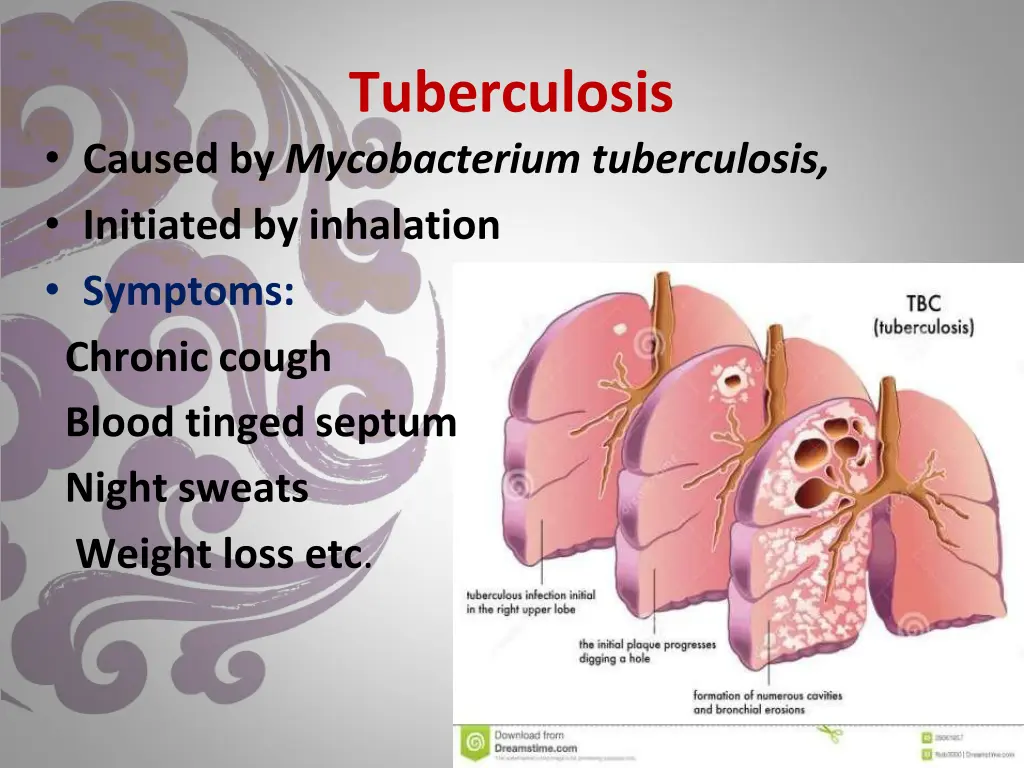 tuberculosis