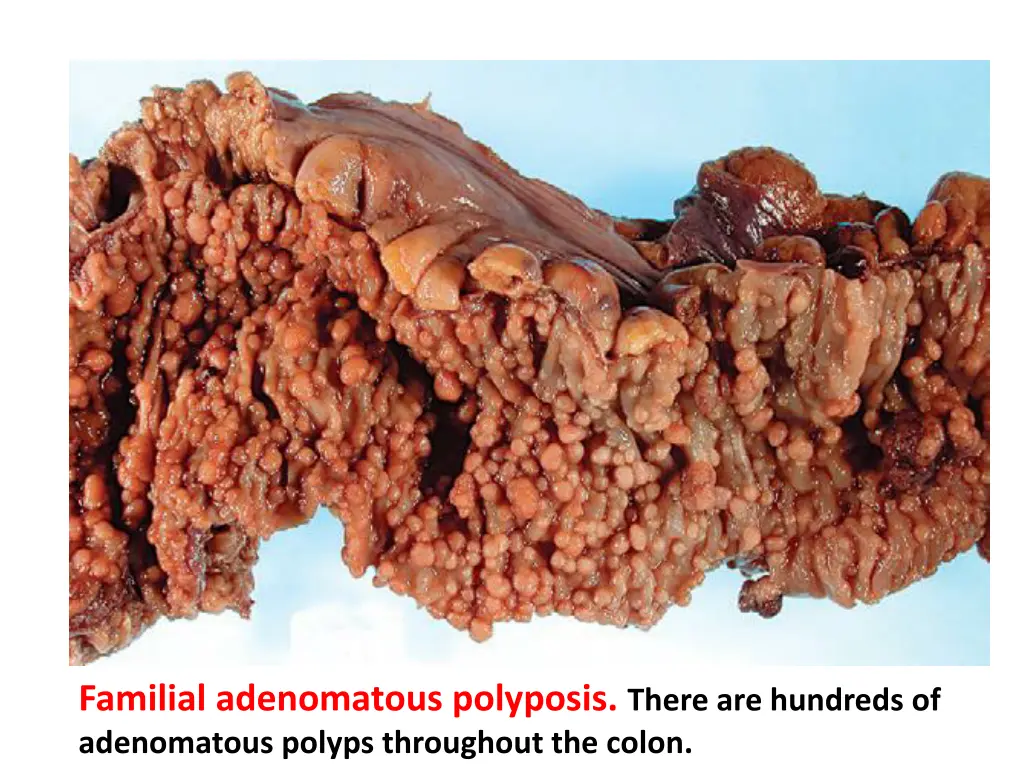 familial adenomatous polyposis there are hundreds