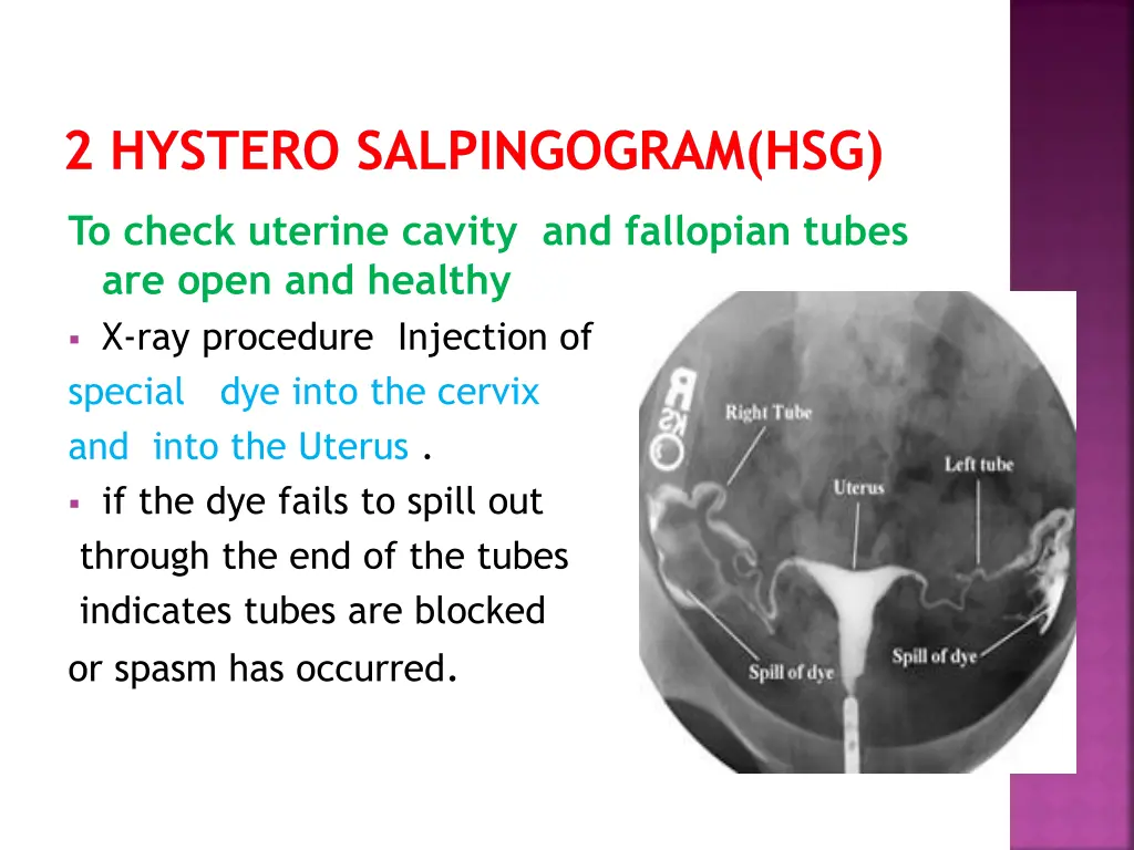 2 hystero salpingogram hsg