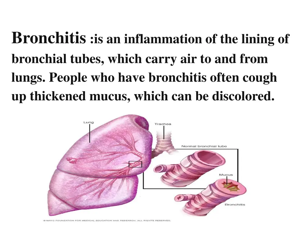 bronchitis is an inflammation of the lining