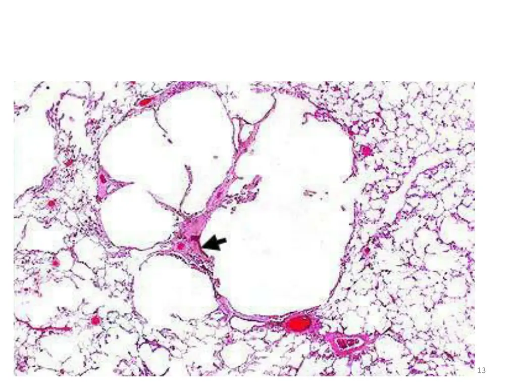 centriacinar emphysema