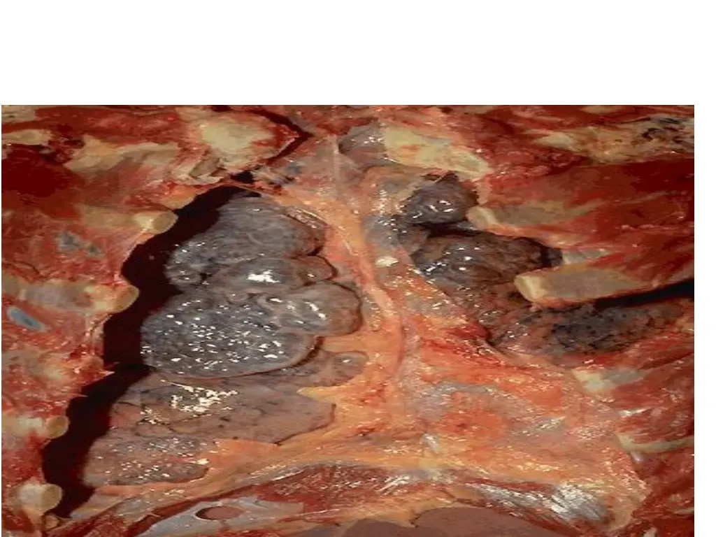 emphysema 2