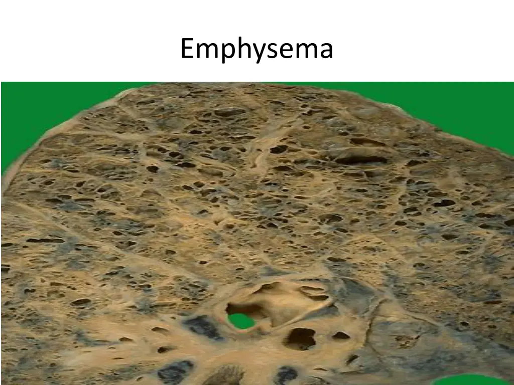 emphysema 3