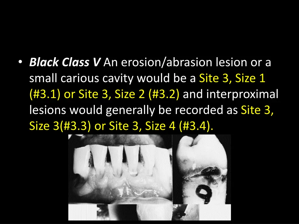 black class v an erosion abrasion lesion