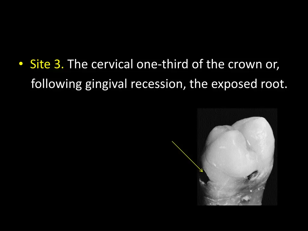 site 3 the cervical one third of the crown