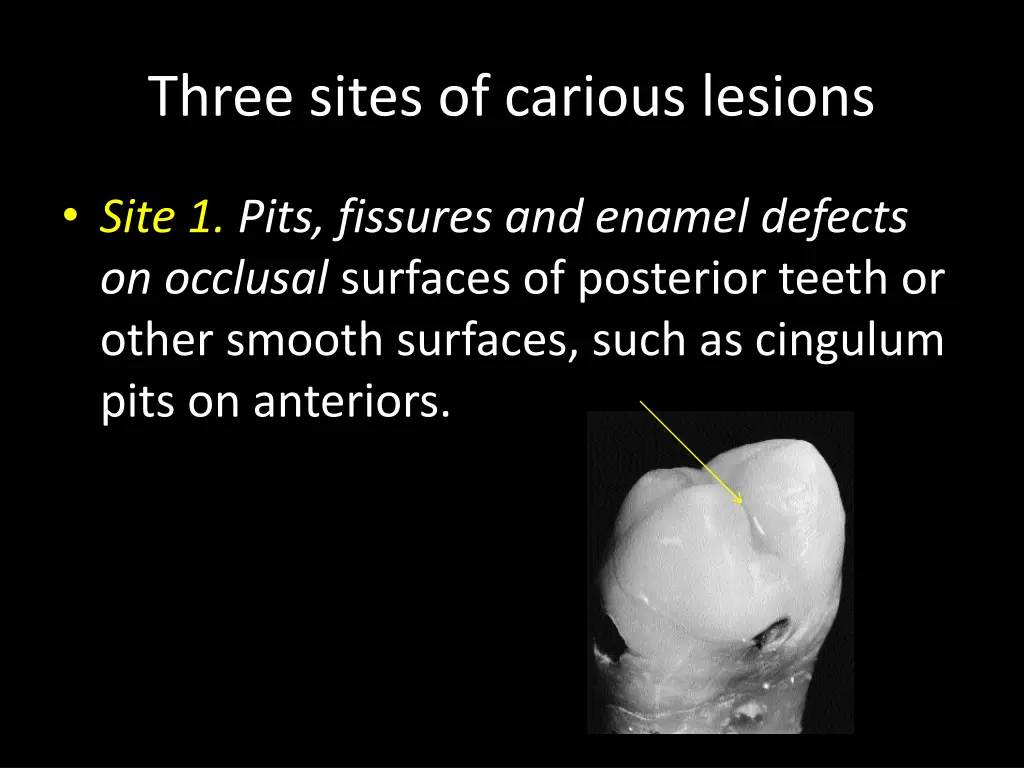 three sites of carious lesions
