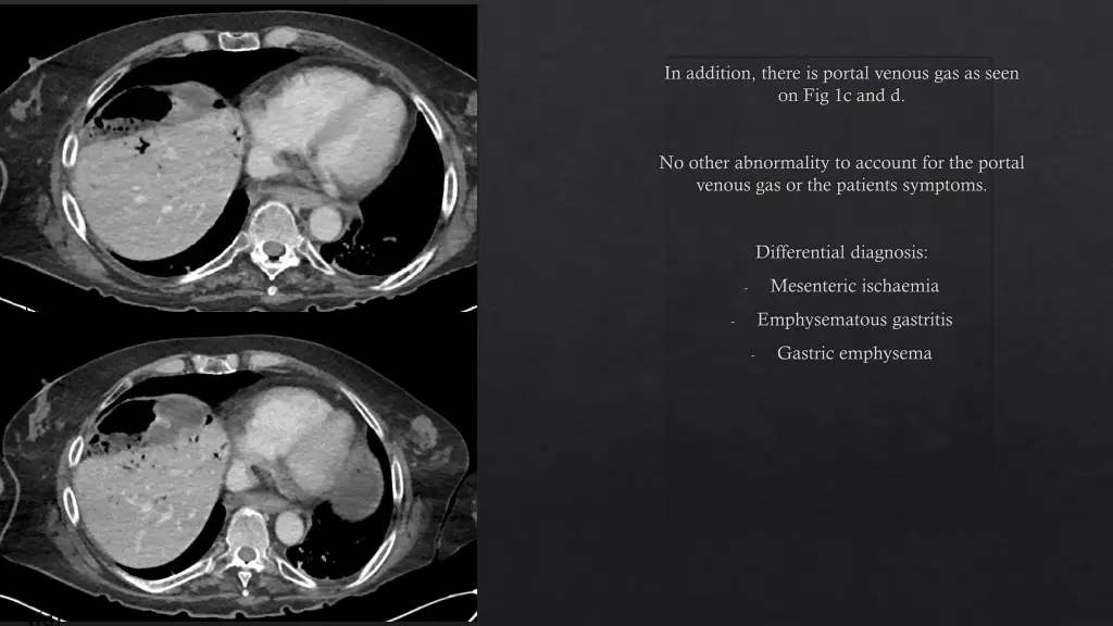 in addition there is portal venous gas as seen
