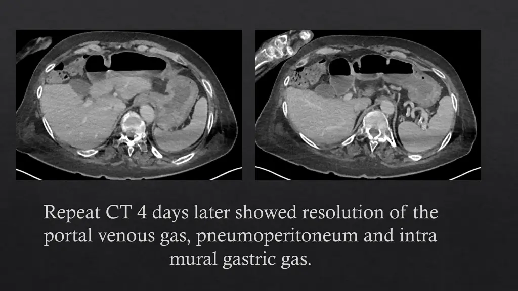 repeat ct 4 days later showed resolution