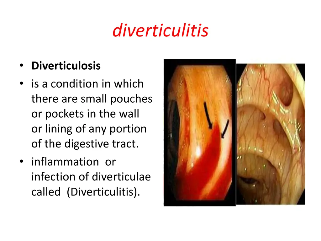 diverticulitis