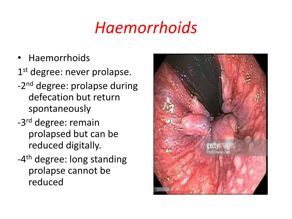 haemorrhoids 1