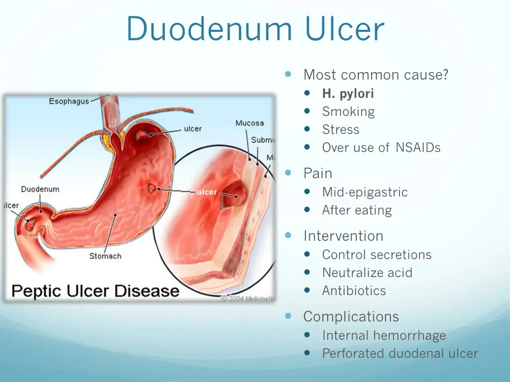 duodenum ulcer
